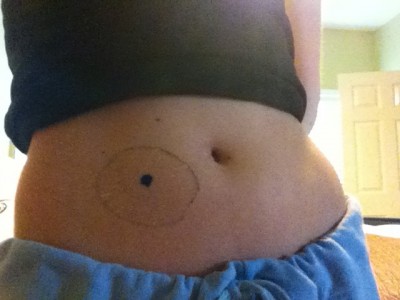 stephanie hughes surgery ileostomy colectomy stolen colon ostomy blog
