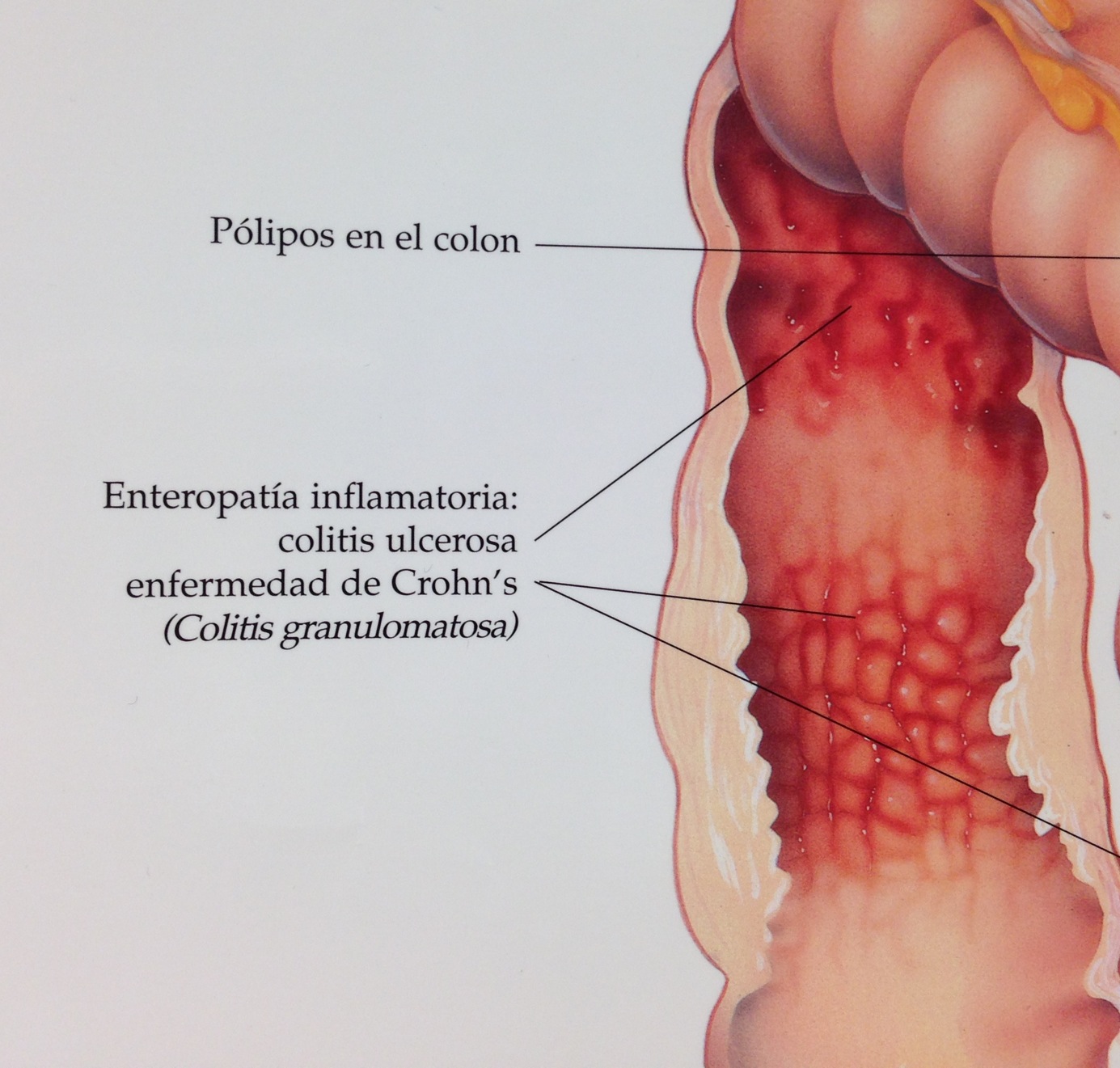 enfermedad de Crohn's disease colitis poster picture stephanie hughes stolen colon ostomy blog