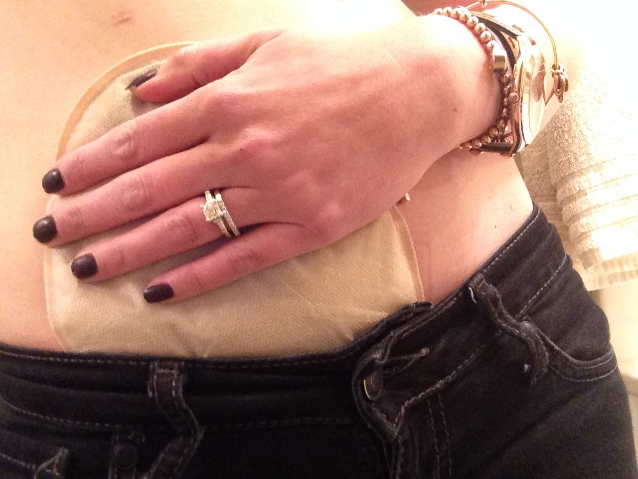 stephanie hughes ostomy crohn's disease ulcerative colitis inflammatory bowel disease ibd ostomy bag blog