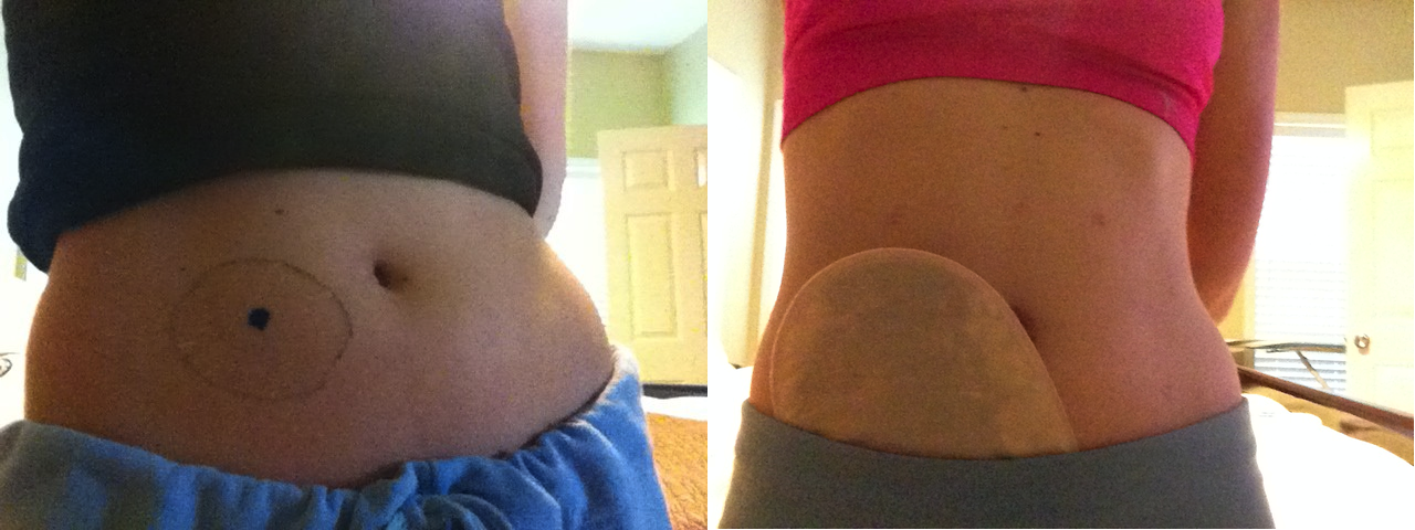stomaversary 2 year anniversary stoma colon ostomy ileostomy blue dot stomach stephanie hughes stolen colon crohn's disease ulcerative colitis inflammatory bowel disease ibd blog ostomy