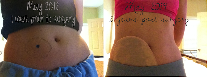 body weight change ostomy surgery colectomy colon stephanie hughes stolen colon inflammatory bowel disease ibd crohn's disease ulcerative colitis ileostomy colostomy urostomy blog