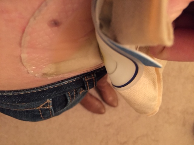 leaks leak output ostomies advice tips tricks stephanie hughes out of the bag colostomy ileostomy crohn's disease ulcerative colitis inflammatory bowel disease ibd ostomy blog stolen colon ileostomy colostomy urostomy