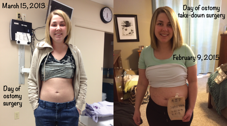Lindsey Russell colostomy jpouch crohn's story OstoMYstory stoma ostomy crohn's disease ulcerative colitis ileostomy colostomy urostomy inflammatory bowel disease ibd stolen colon