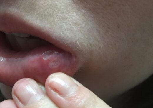 Stephanie Hughes family The Stolen Colon ostomy bag blog breaking down the ostomy barrier mouth ulcer canker sore