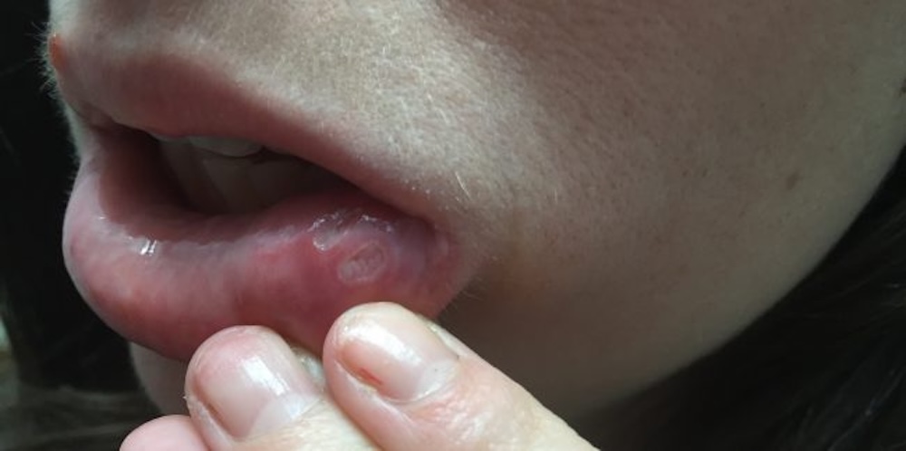 Stephanie Hughes family The Stolen Colon ostomy bag blog breaking down the ostomy barrier mouth ulcer canker sore
