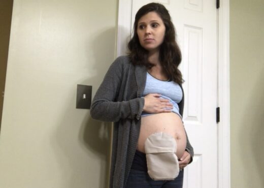 Stephanie Hughes family The Stolen Colon ostomy bag blog breaking down the ostomy barrier pregnancy IBD
